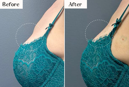 bra dips before and after